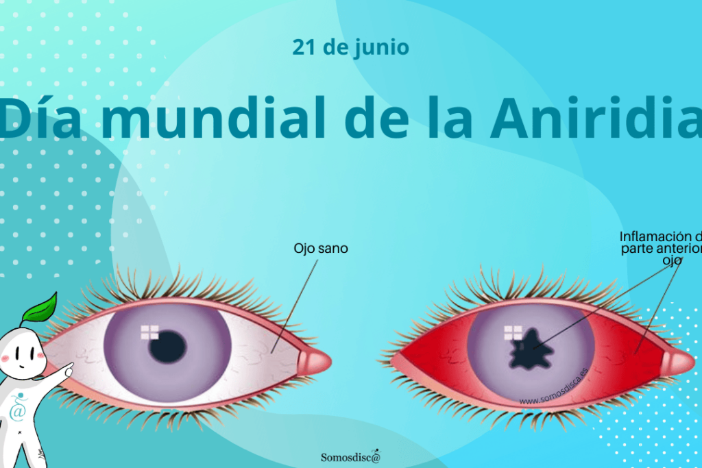 dia internacional de la aniridia 21 de junio
