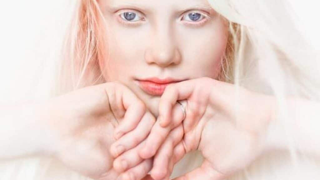 dia internacional de sensibilizacion sobre el albinismo 13 de junio