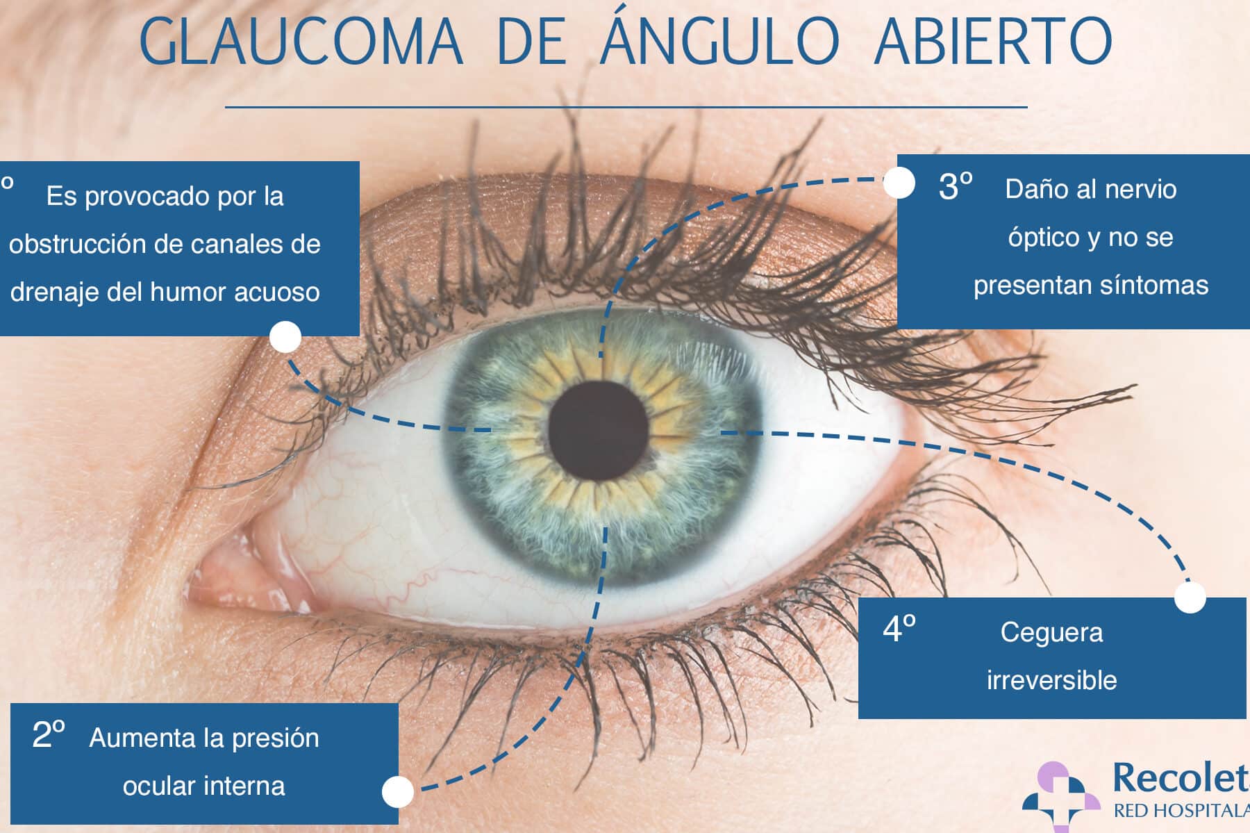 dia mundial del glaucoma 12 de marzo