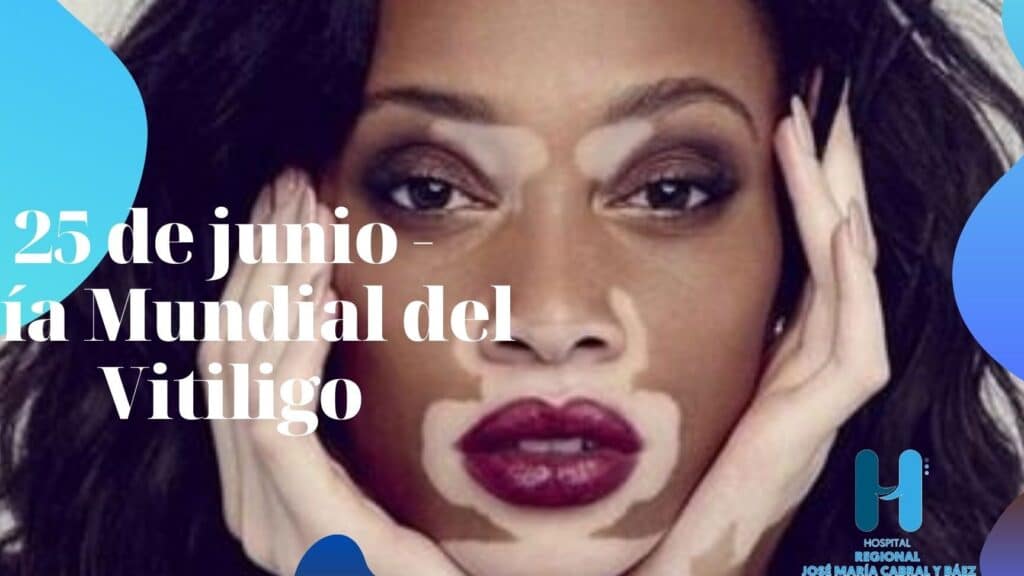dia mundial del vitiligo 25 de junio